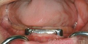 Kuva: Proteesit implantteilla, joissa palkki lukko