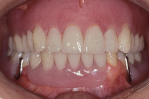 Foto: Dentaduras removíveis nas maxilas superiores e inferiores