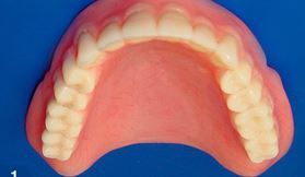 Photo: Removable upper jaw prosthesis