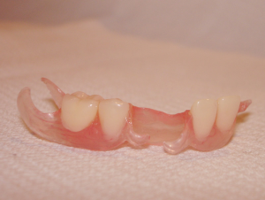 Foto: gigi palsu yang boleh ditanggalkan sebahagiannya