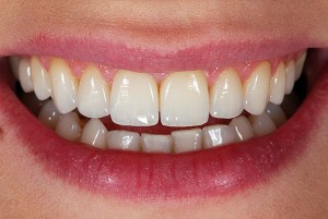 Photo: Zirconium crowns on the front teeth
