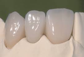 Photo: The natural appearance of metal-free ceramic crowns due to the transparency of the material