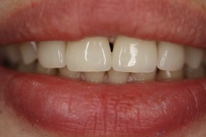 Foto: Pròtesi de dents frontals amb ceràmica no metàl·lica