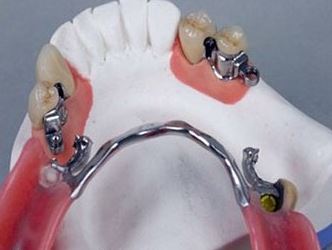 Photo: Éléments de fixation de la prothèse de fermoir sur les dents