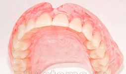 Foto: gigi palsu yang boleh ditanggalkan di atas rahang atas