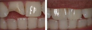Foto: Antes e depois da restauração dentária com verniz