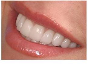 الصورة: الأسنان بعد الترميم مع القشرة