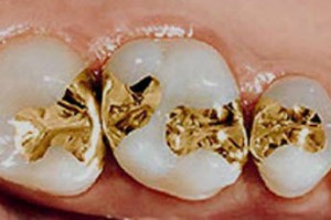 Foto: Restauração de dentes com incrustações de metal