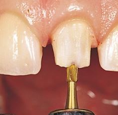 Kuva: Hampaan valmistelu palauttamista varten
