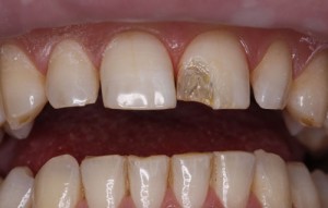 Foto: Destruição do dente da frente - uma indicação para restauração estética