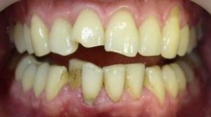 Foto: dientes astillados y dentición