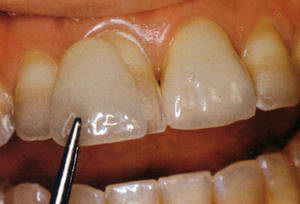 Kuva: Viilujen asentaminen hampaiden väriä muutettaessa