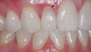 phục hồi bởi veneers sau