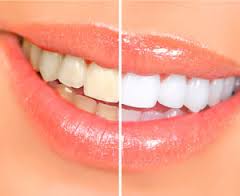 Foto: Zähne vor und nach kosmetischer Restauration