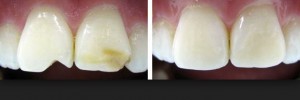 Foto: Antes e depois da restauração dos dentes da frente lascados