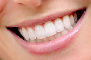 Foto: Dentes após restauração com facetas
