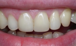 Foto: Dentes após restauração com fotopolímeros