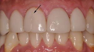 Nuotrauka: nesėkmingas restauravimas naudojant fotopolimerus ant viršutinio danties