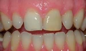 Foto: Escurecimento do esmalte do dente da frente após extensão
