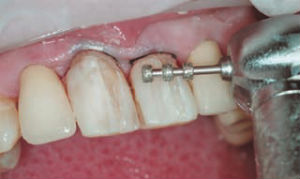 Foto: preparazione dei denti per faccette