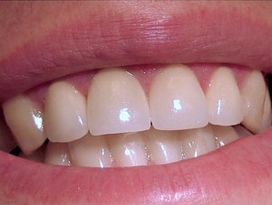 الصورة: استعادة فنية للأسنان مع القشرة