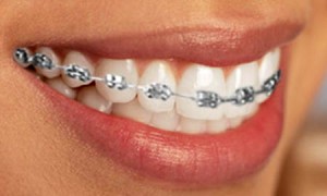 Photo: Correction of malocclusion with braces