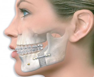Foto: Operació a la mandíbula inferior