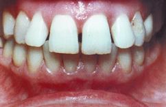 Фото: Зуби пре оклузије