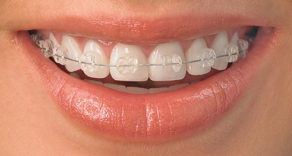 Fotoğraf: Malokluzyonun diş telleriyle düzeltilmesi