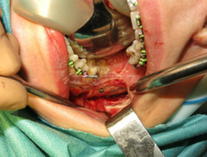 Foto: Jedna z fází operace