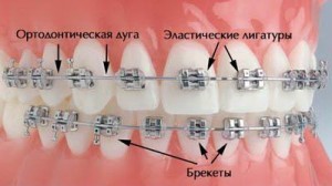 Foto: Correção de dentes com aparelho