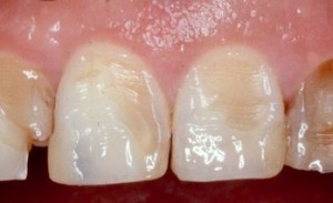Φωτογραφία: Διάβρωση του σμάλτου των δοντιών