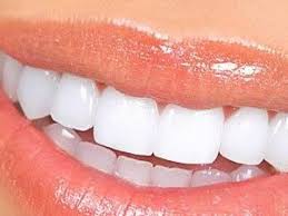 Kuva: Hampaat ammatillisen valkaisun jälkeen