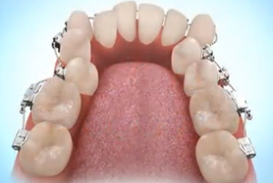 foto antes de fixar os dentes com aparelho