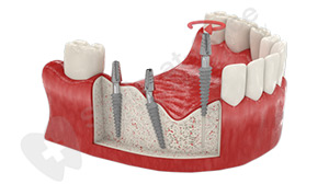implanti-na-gevatelnie-zubi