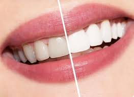 Photo: Dents: avant et après blanchiment