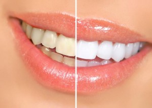 Foto: Zähne vor und nach dem Bleaching