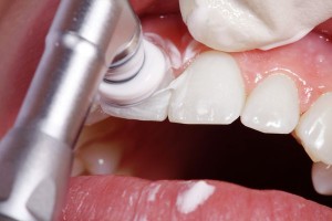 Foto: Fluoridierung der Zähne nach dem Bleaching